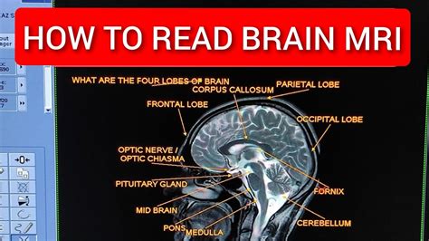 Brain MRI: How to read MRI brain scan .